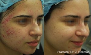 Example of acne scar treatment