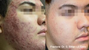 Example of acne scar treatment