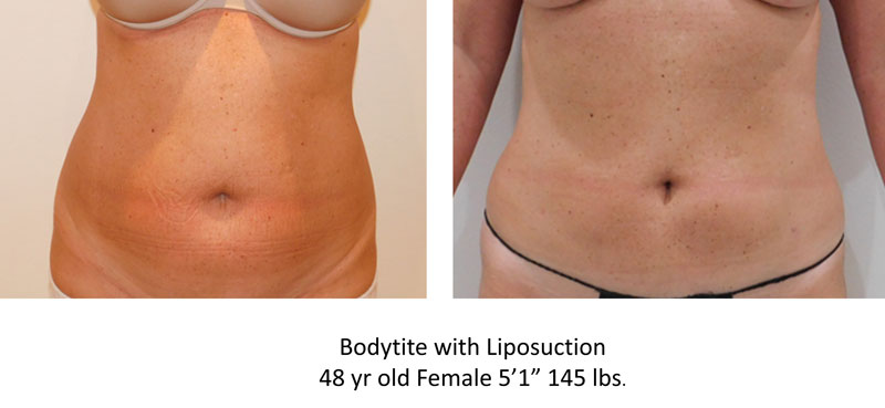BodyTite wtih Liposuction before and after