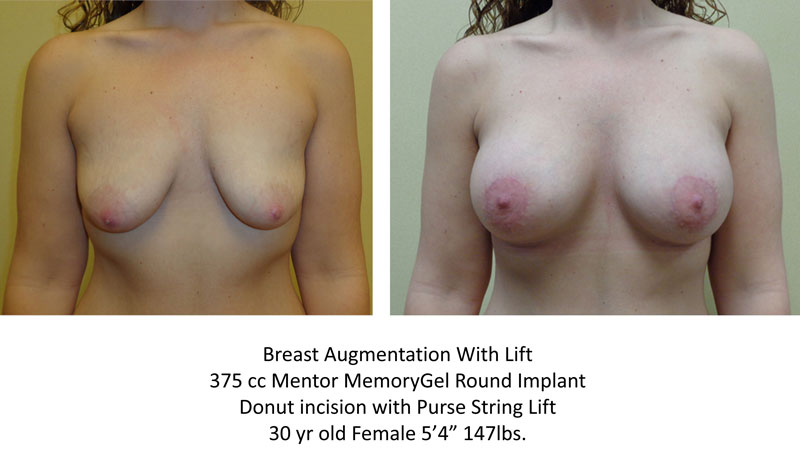 Breast Augmentation with lift before and after