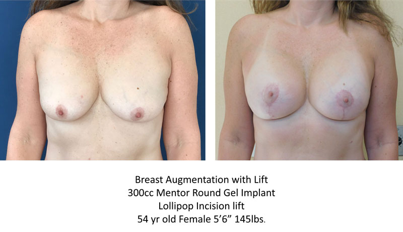 Breast Augmentation with lift before and after