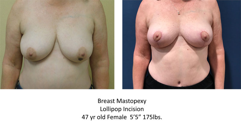 Breast Lift before and after