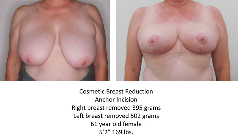 Breast Reduction before and after