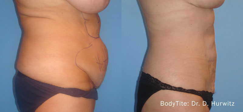 BodyTite before and after