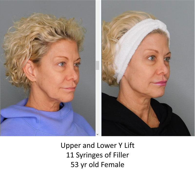 Ylift before and after