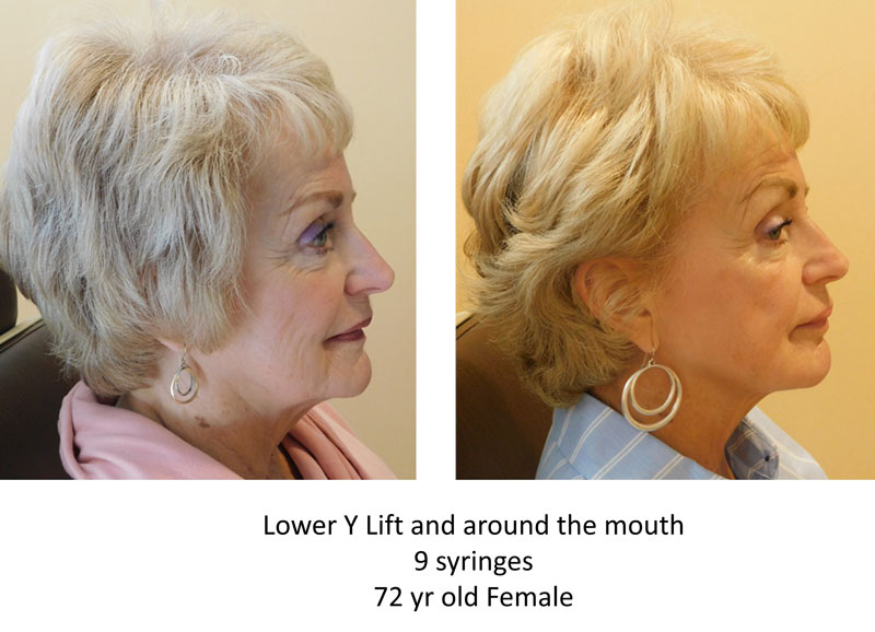 Ylift before and after